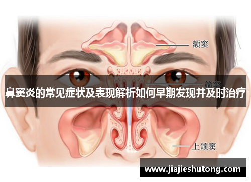 鼻窦炎的常见症状及表现解析如何早期发现并及时治疗 鼻窦炎的常见症状及表现解析如何早期发现并及时治疗